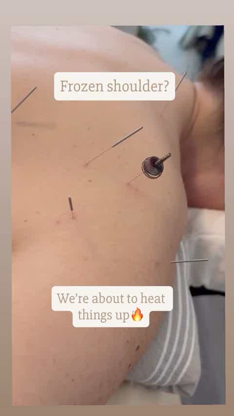 Frozen shoulder doesn’t have to stay frozen. 🔥 

This is moxibustion at work—ancient heat therapy t...