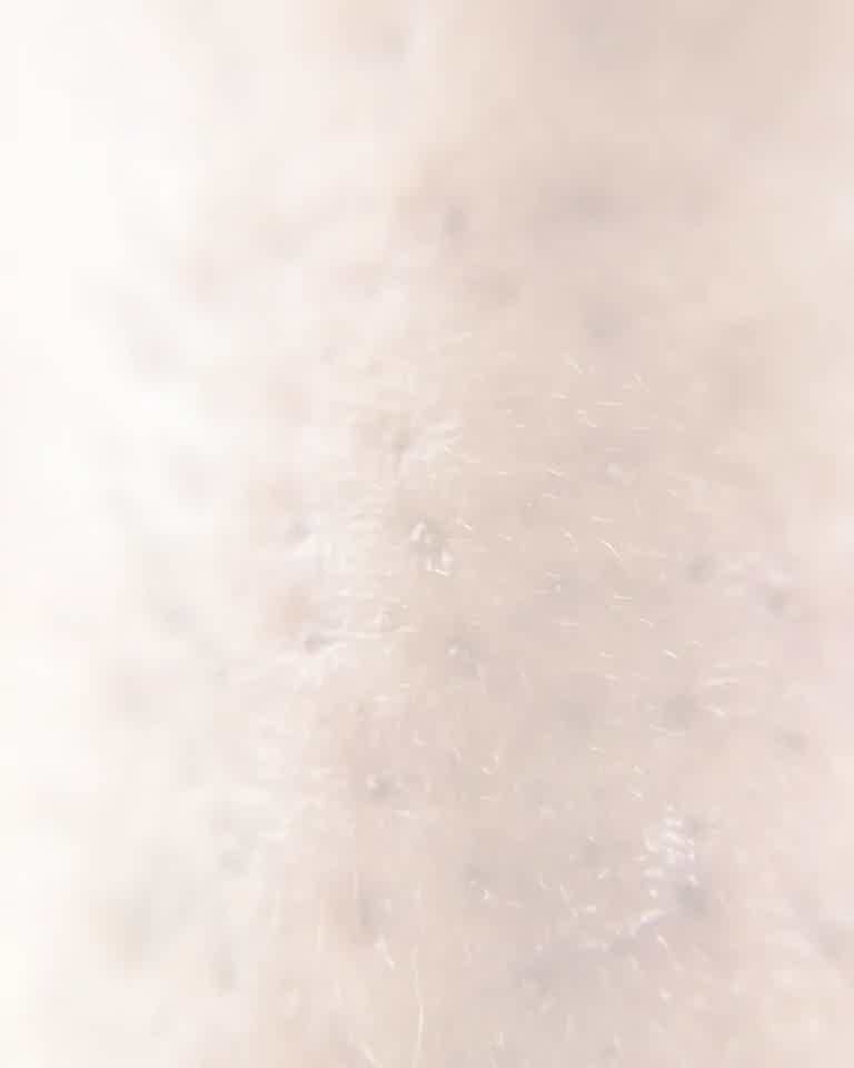 Close-up of skin showing congestion and pores, highlighting a skin concern treated at BioRevive clinic in Calgary.