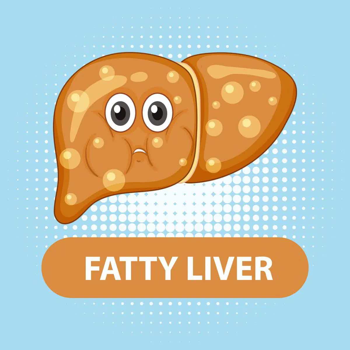 Glutathione in the Treatment of Fatty Liver/NASH/NAFLD
