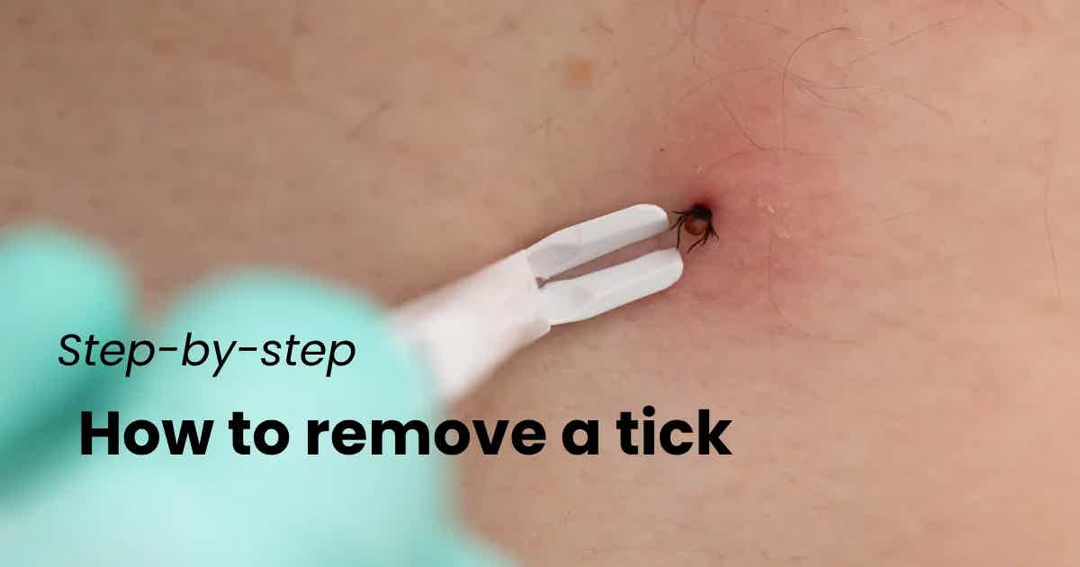 What to Do If Your Child Gets a Tick Bite (Step-by-Step Removal Guide for Parents)