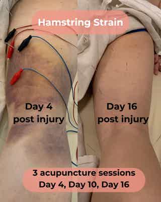 Split photo of hamstring strain recovery: bruising Day 4 vs improved Day 16 after acupuncture sessions (Day 4, 10, 16).