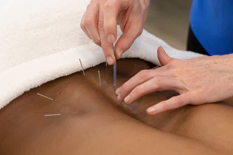 Hands performing acupuncture treatment on a patient