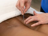 Acupuncture vs. Dry Needling: Understanding the Overlap, the Differences, and Why It Matters