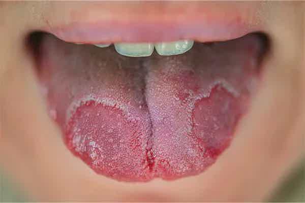 Geographic Tongue: What Those Map-Like Patches on Your Tongue Say About Your Gut