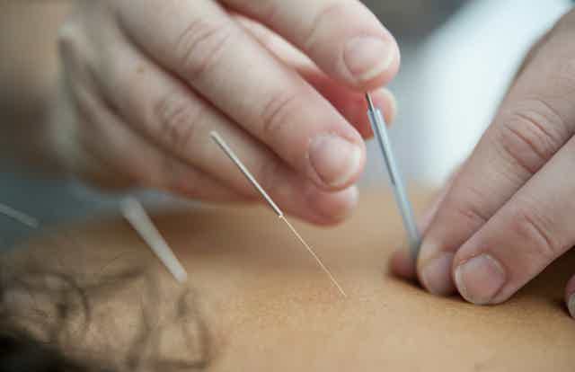Acupuncture needles inserted and manipulated on skin during treatment.