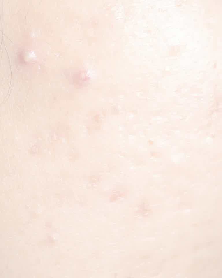 Close-up of mild acne on skin showing inflamed pimples, highlighting acne concern treated at Biorevive in Calgary.
