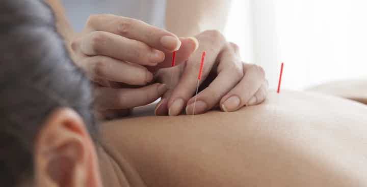Does Acupuncture Help with Pain?