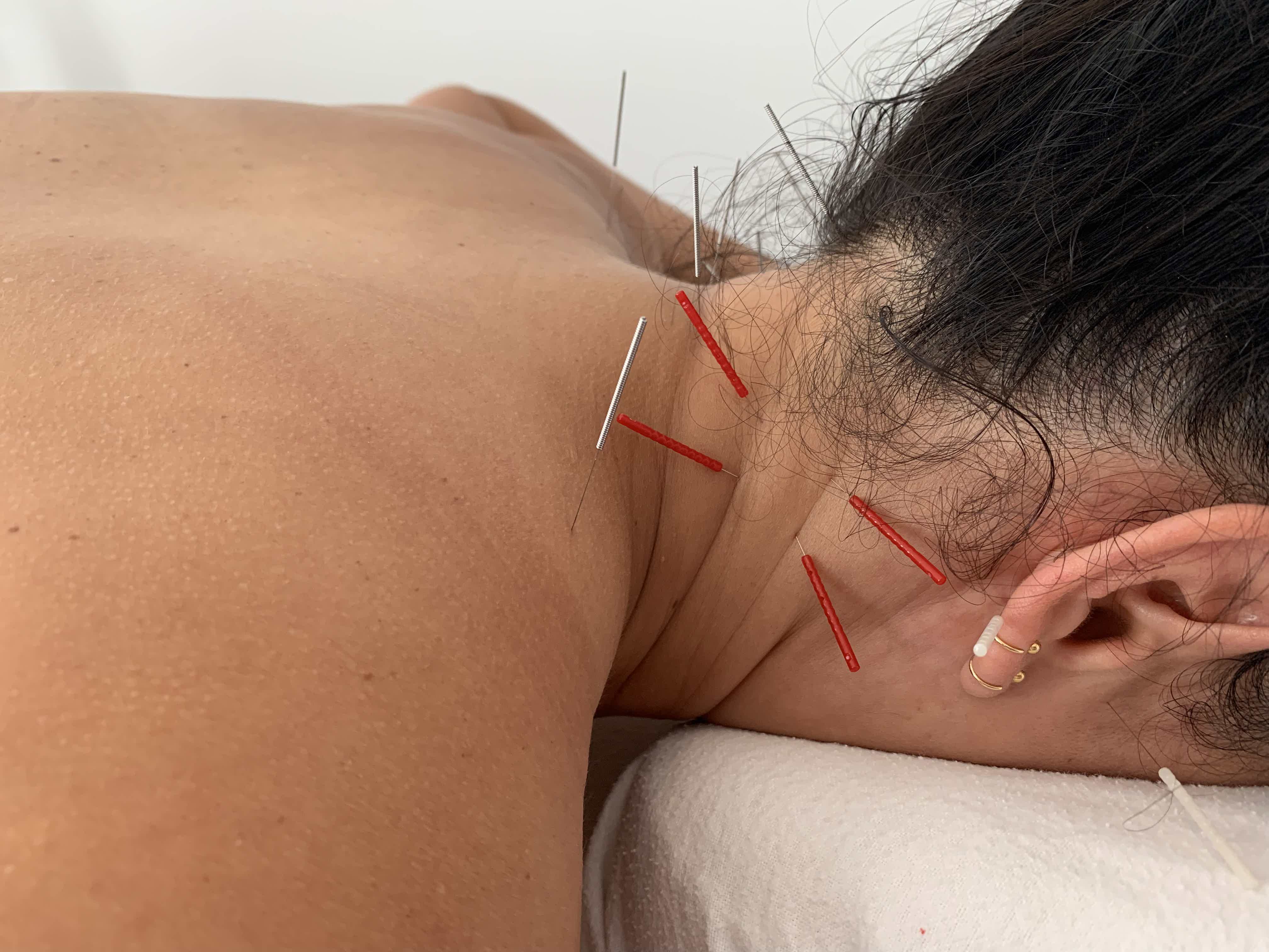 Close-up of an acupuncture session on a person’s neck and upper back.