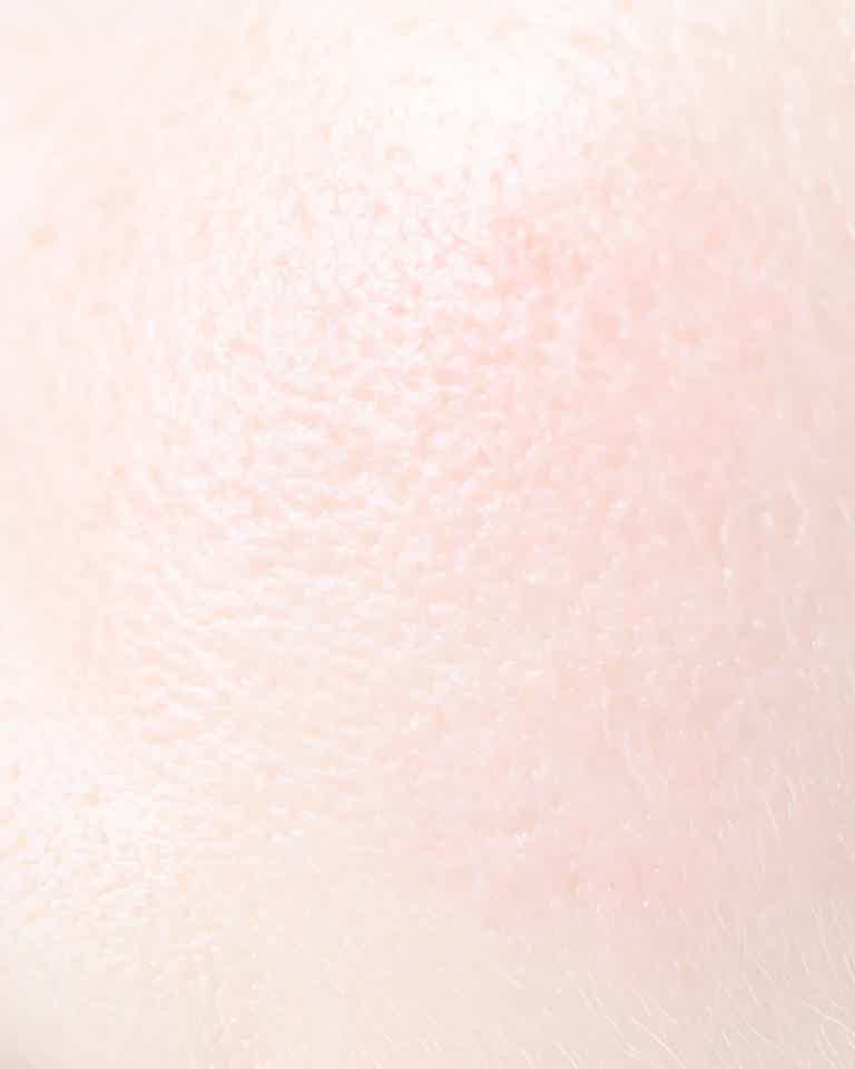 Close-up of facial redness and visible blood vessels on a patient undergoing skin treatment at Biorevive Calgary clinic.