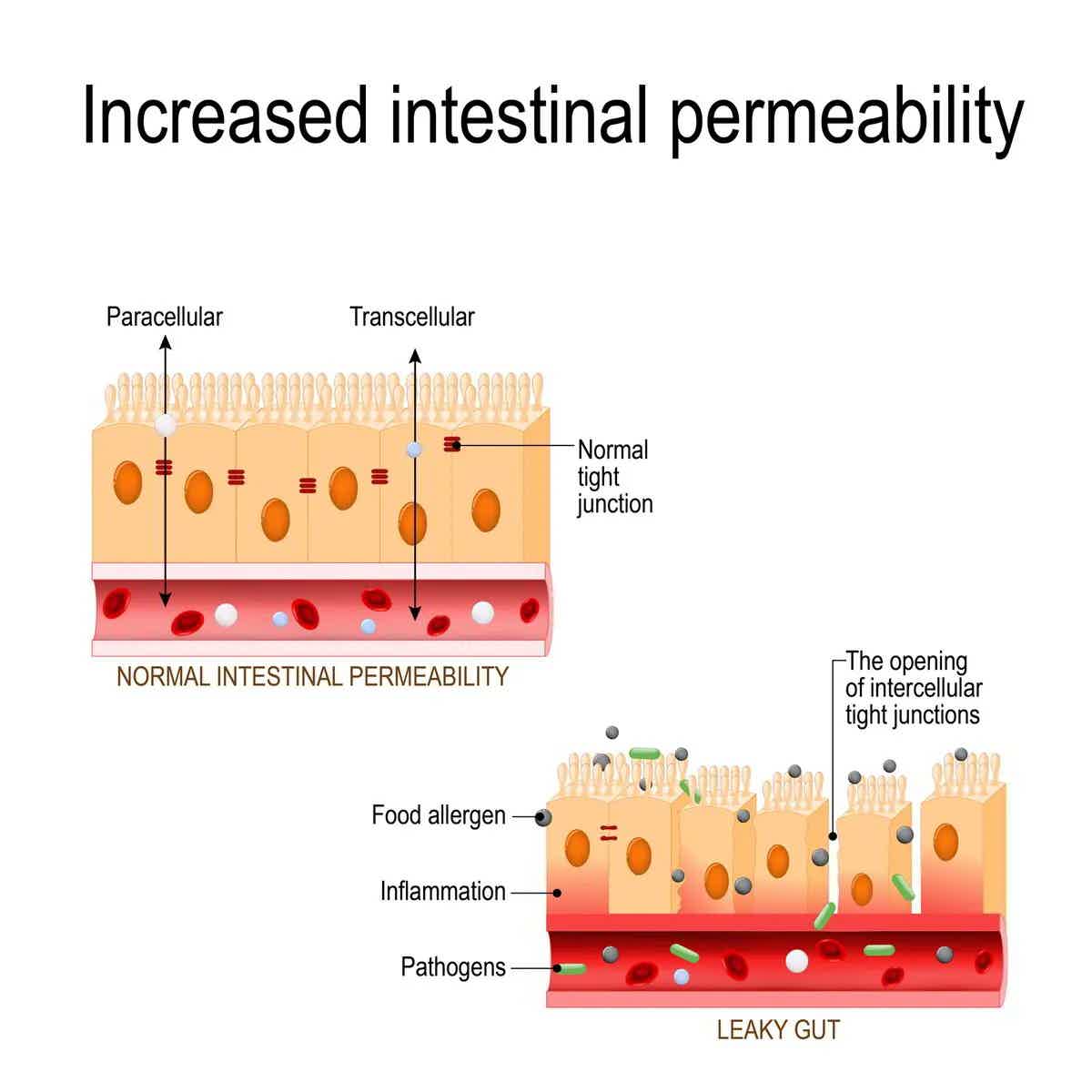 What is "leaky gut" (intestinal permeability)? And how do you fix it?