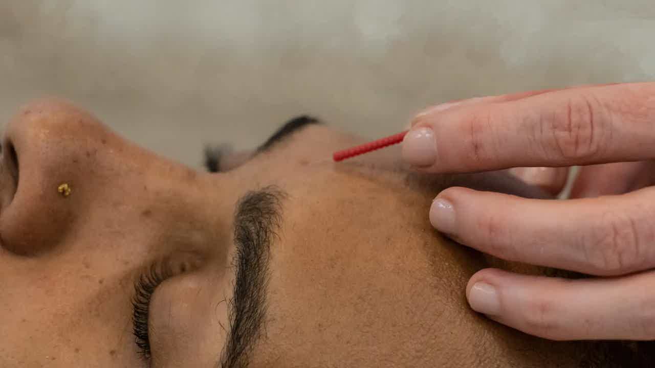 Close-up of a woman receiving facial acupuncture while essential oil is prepared for a relaxing wellness treatment.