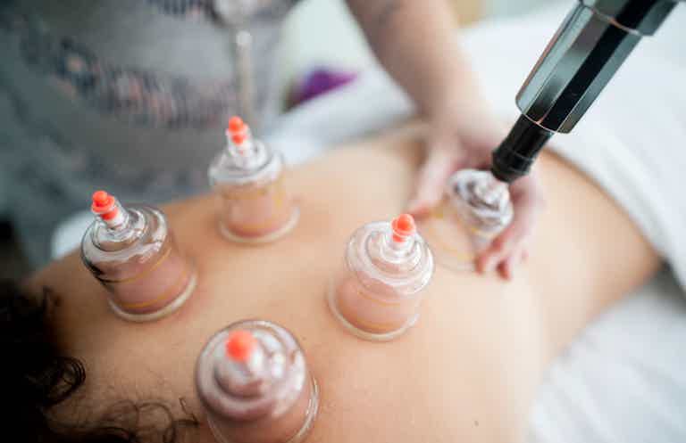 Therapist applying cupping therapy on client