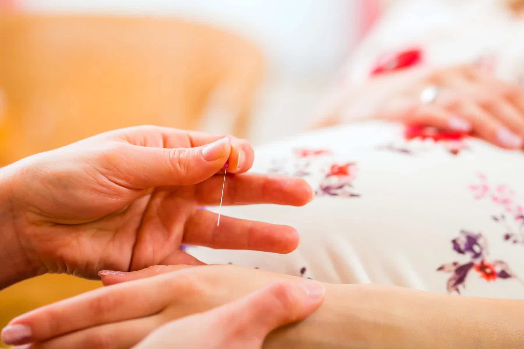 Top Acupuncture FAQs: Your Questions Answered