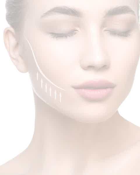 Woman receiving aesthetic treatment at BioRevive Calgary, with illustrated lines and arrows on her cheeks showing targeted lifting and rejuvenation effects for injectable and skin booster treatments.