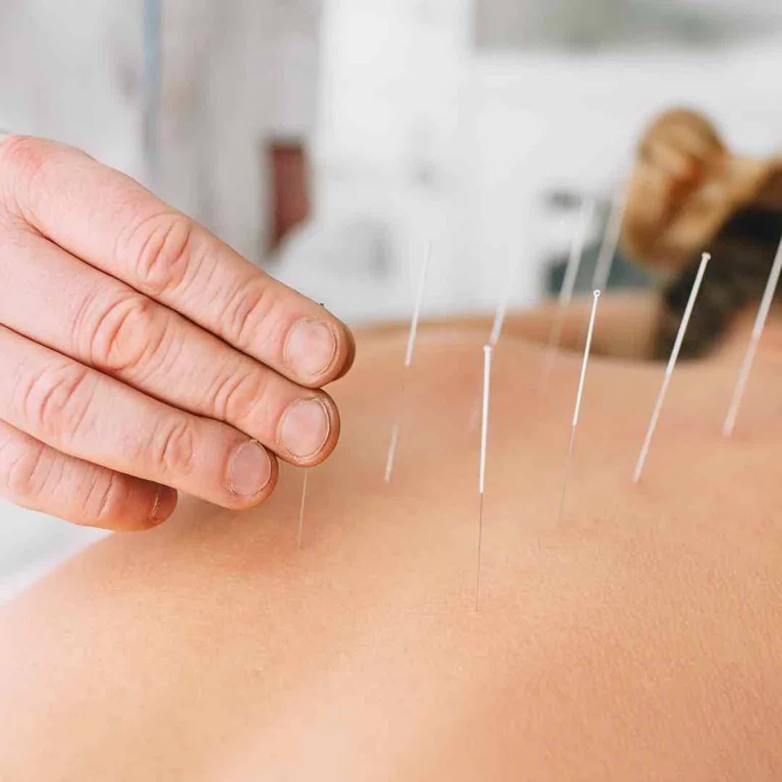 Healthcare worker’s fingers pressing skin while acupuncture needles are inserted and aligned on forearm.