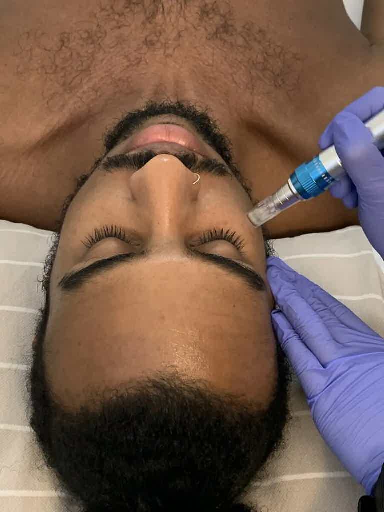 microneedling, relaxed face
