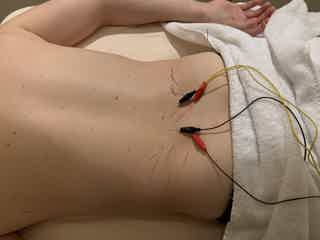 Back of a person lying on a bed with loose electrode wires and adhesive lead pads attached for stimulation.