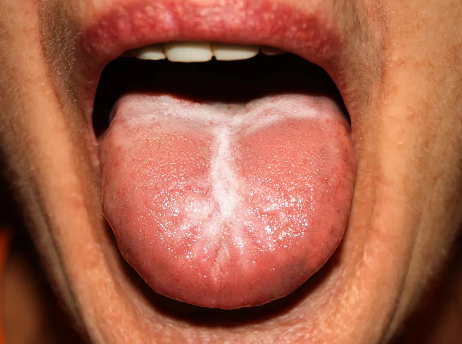Intestinal Candidiasis: Causes, Symptoms and Treatment