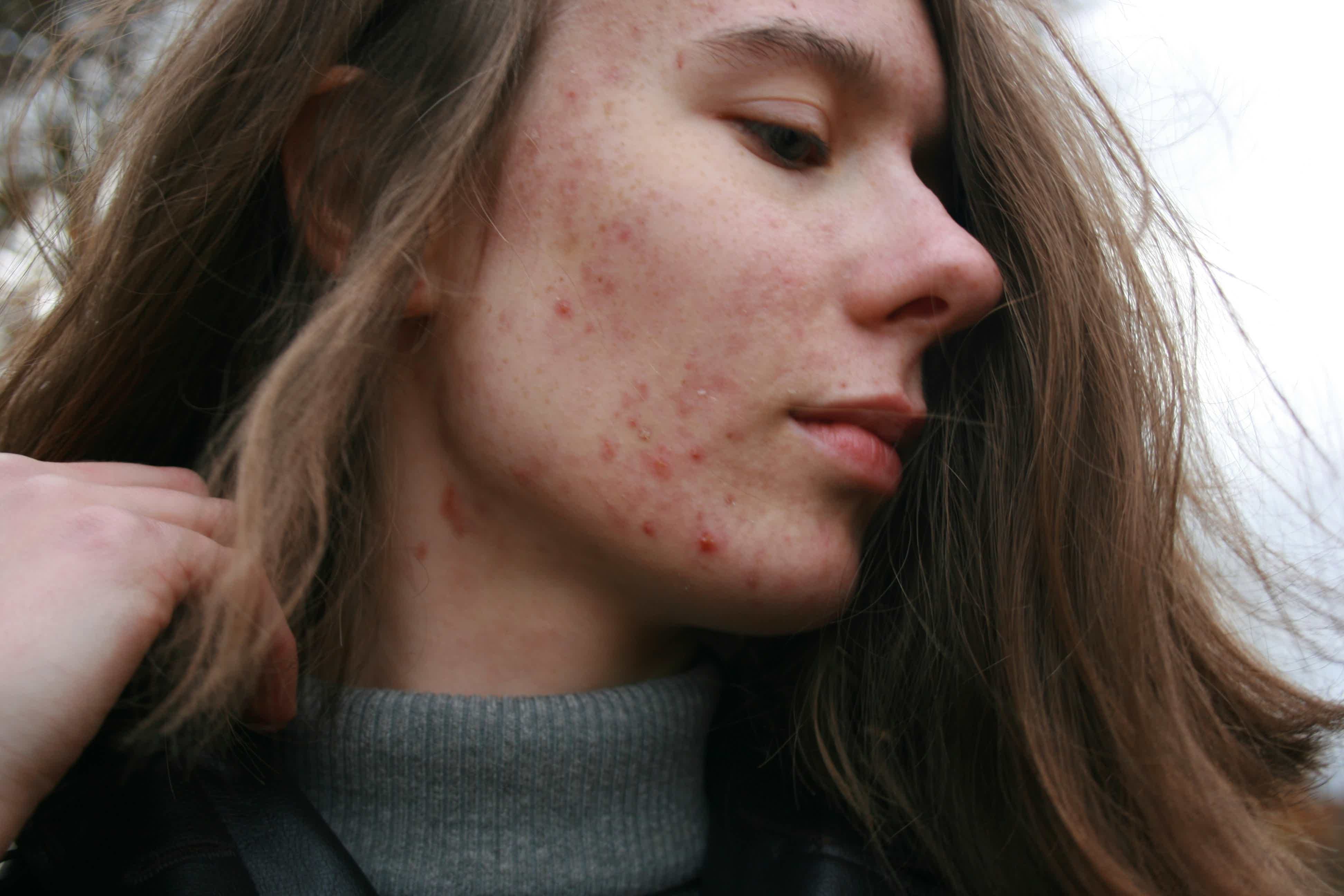 Close-up of woman with freckles and red acne-like breakouts on cheek and chin, looking down, outdoors.