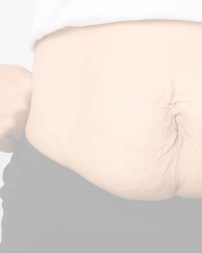 Body skin tightening treatment at BioRevive Calgary, improving skin laxity, stimulating collagen, and enhancing firmness and tone for smoother, more youthful-looking skin.