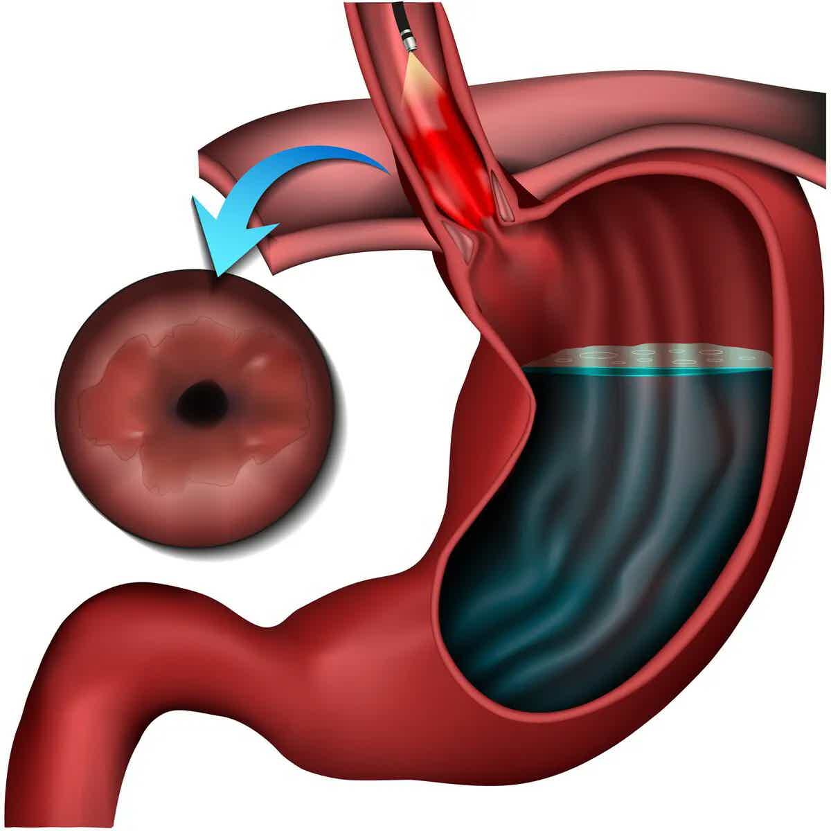 Barrett's Esophagitis: Causes, Symptoms, Treatments, and When to Seek Medical Help