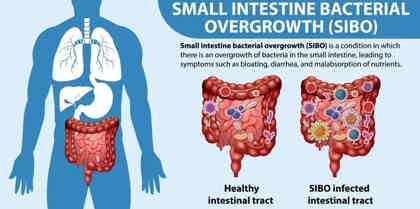 How To Treat SIBO Naturally: Diet, Herbs, and Timeline