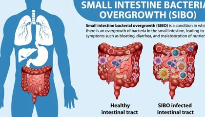 How Long Does it Take to Treat SIBO Naturally? Herbal Remedies & Diet