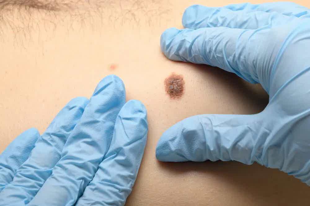ABCDEs FOR MELANOMA