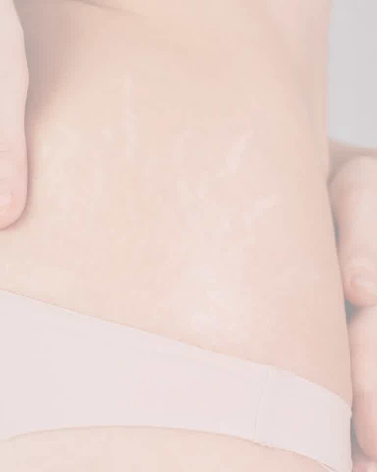 Stretch mark treatment at BioRevive Calgary, using professional skin remodeling techniques to improve texture, stimulate collagen, and support firmer, smoother skin..