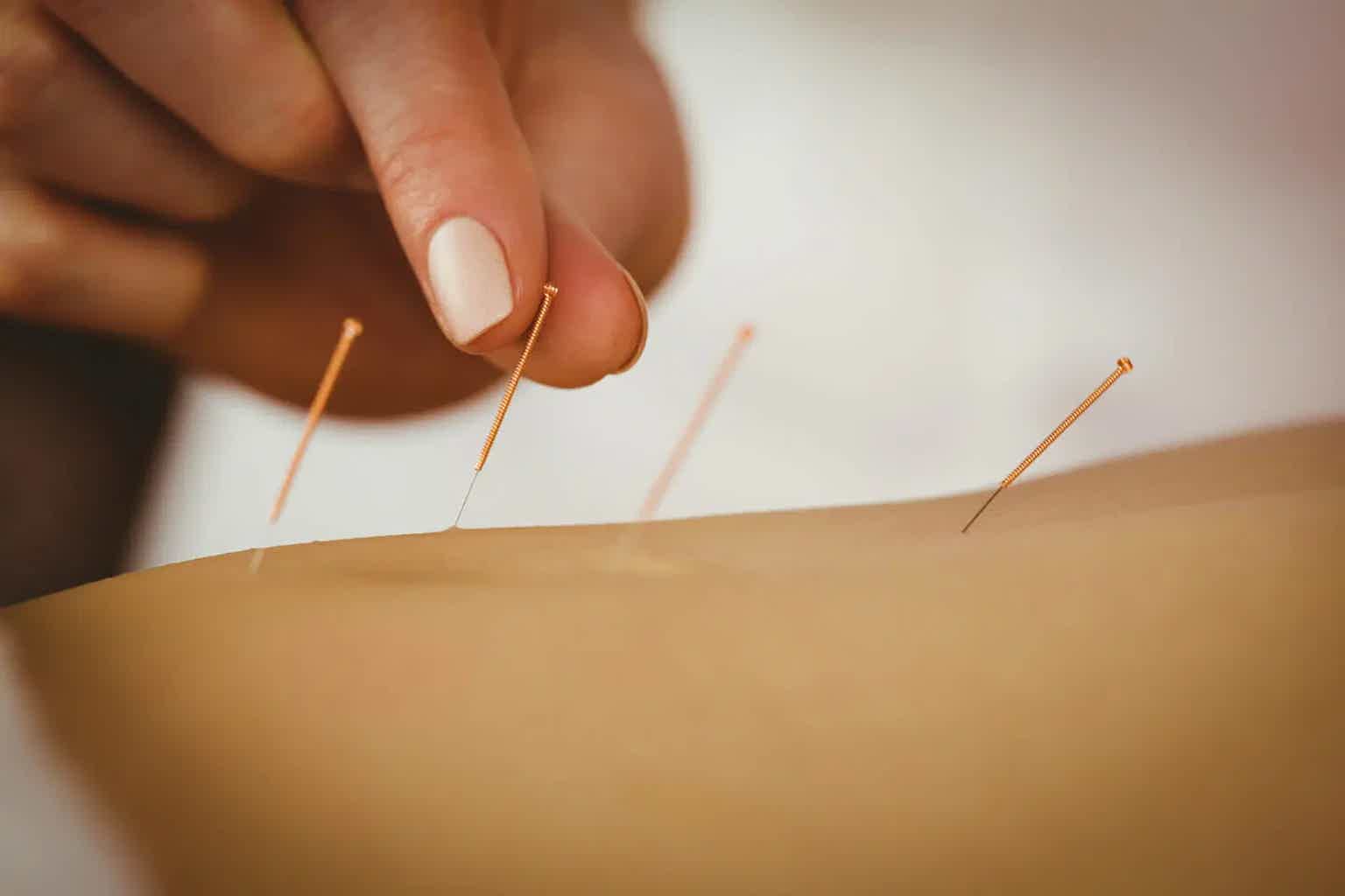 Hand holding gold acupuncture needle on forearm with several fine needles in place on skin.