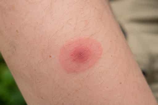 Close-up view of a person’s arm, showing a bull’s eye rash, one of the symptoms of Lyme disease.