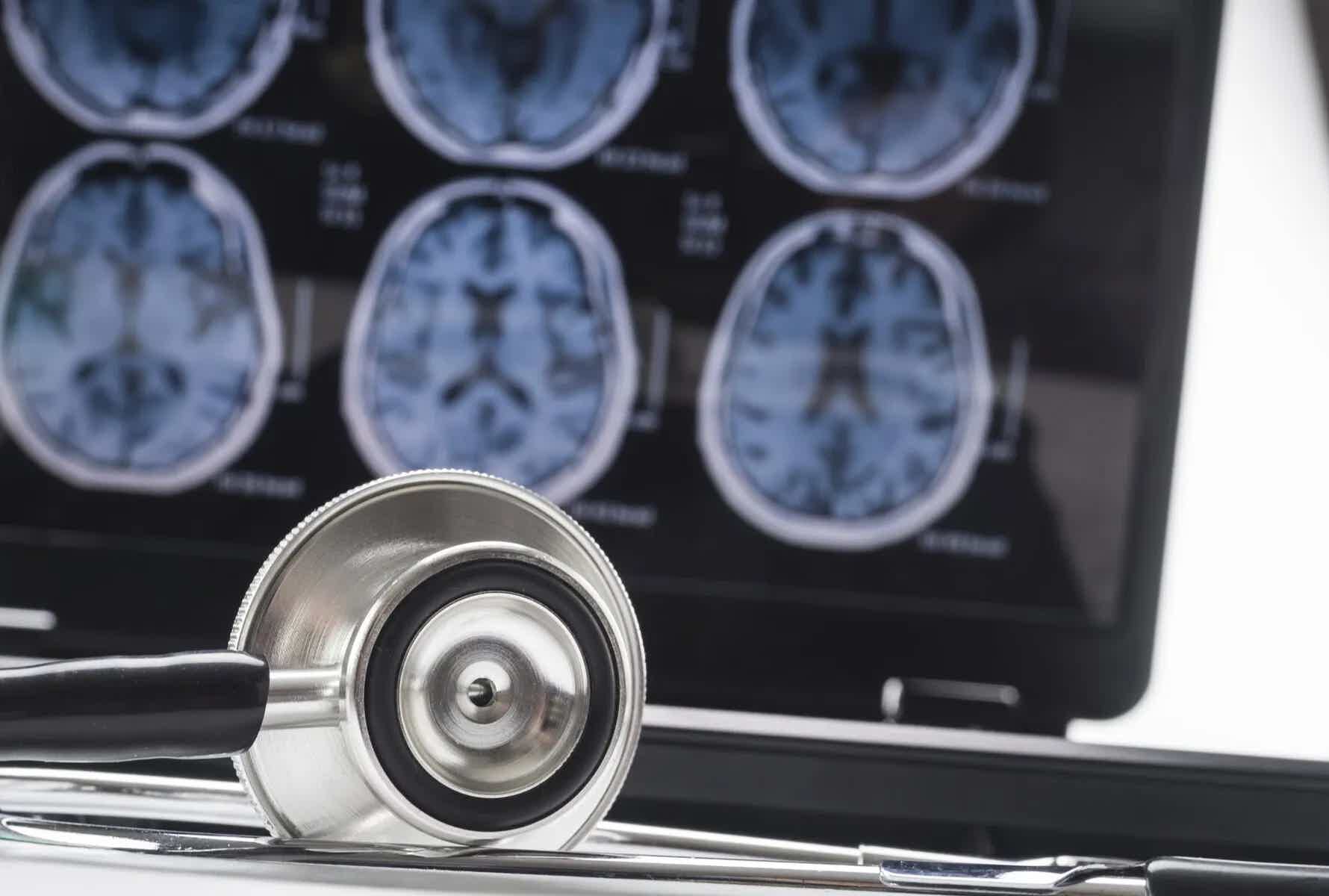 Naturopathic Supports for Alzheimer's Disease