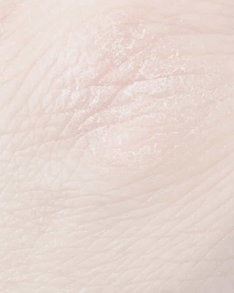 Close-up of dry, flaky skin highlighting dryness concern treated at Biorevive in Calgary.