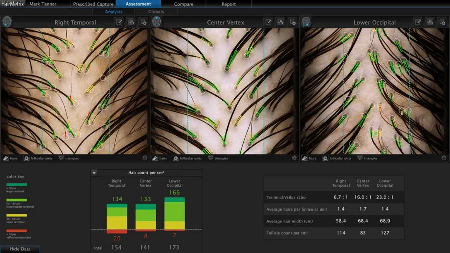 Close-up of scalp with numerous hair follicles highlighted in green, showing hair roots and patterns.