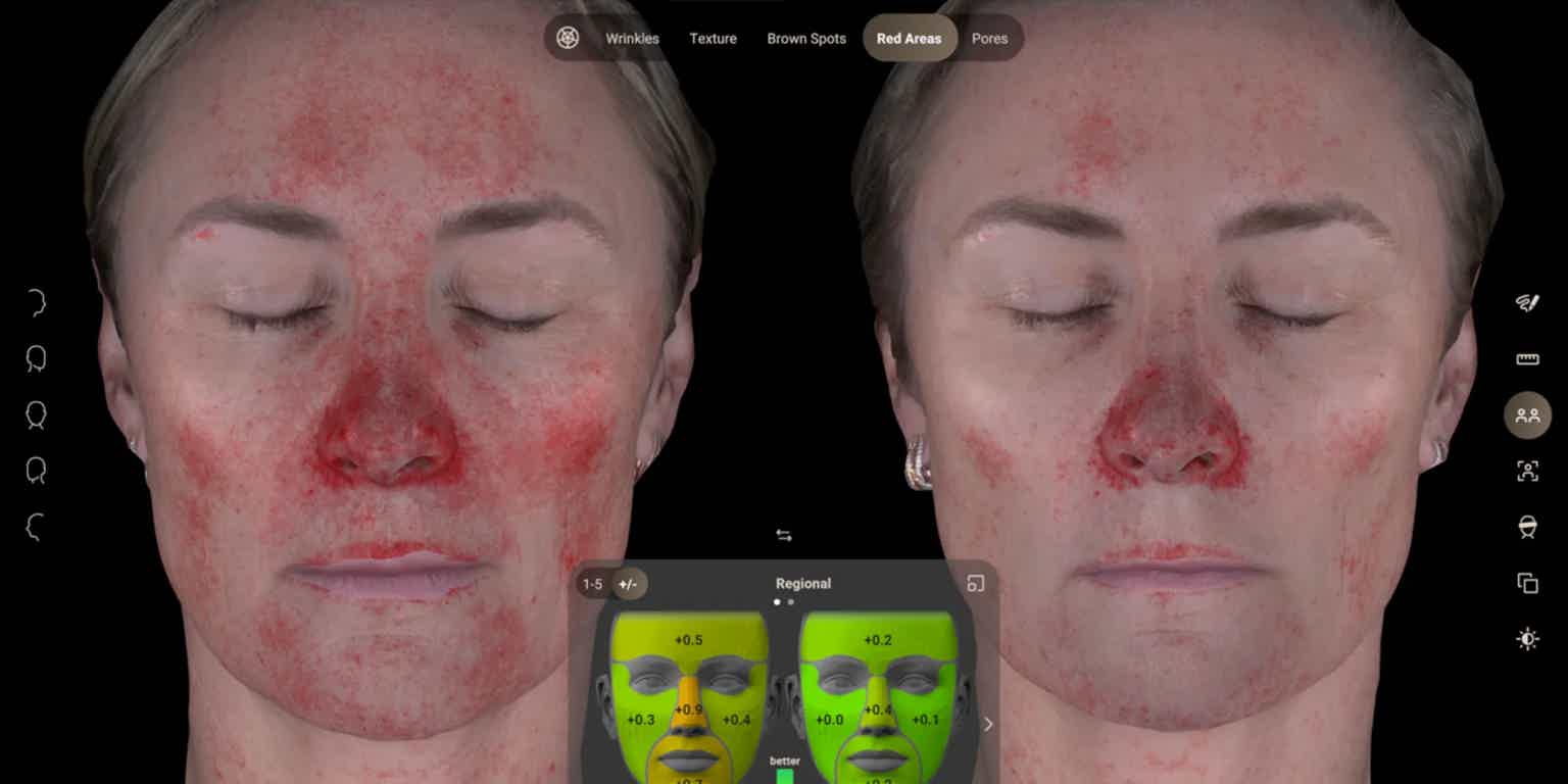 Before and after AURA skin reality images showing reduced redness and inflammmation on face 10 days post microneedling with VAMP at Biorevive Calgary.