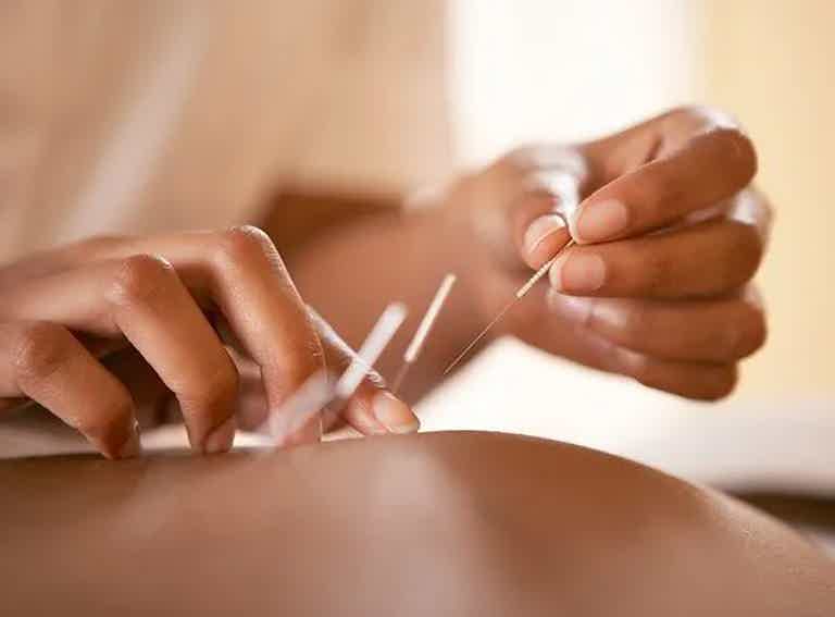 Hands performing acupuncture treatment on a patient